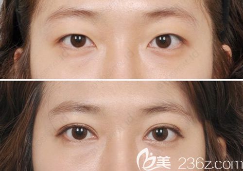 韓國id埋線雙眼皮案例