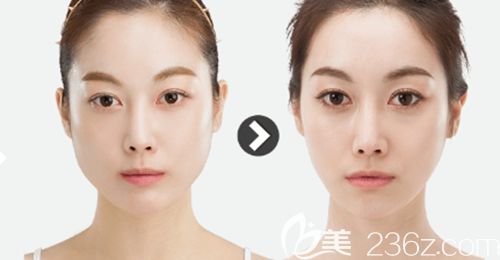 韓國ID全臉脂肪填充案例