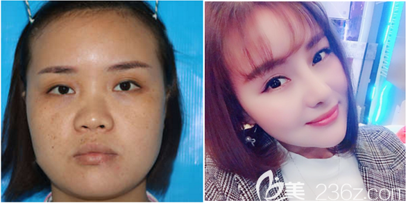 東莞壹加壹何敏做的隆鼻和脂肪填充案例