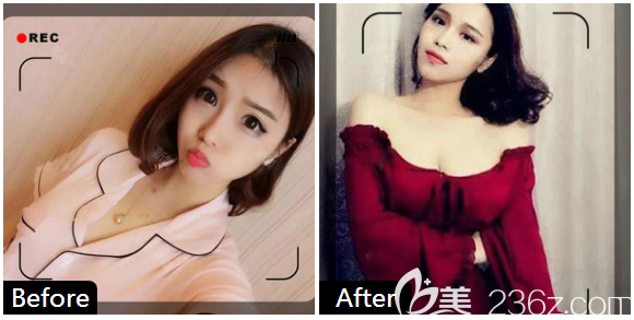 東莞壹加壹何敏醫(yī)生隆胸案例