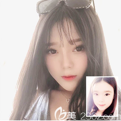 東莞壹加壹何敏醫(yī)生雙眼皮案例