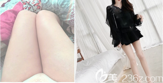 東莞壹加壹王擎主任大腿吸脂案例