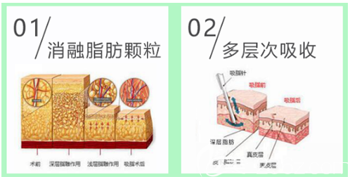 東莞壹加壹吸脂優(yōu)勢 東莞壹加壹吸脂優(yōu)勢