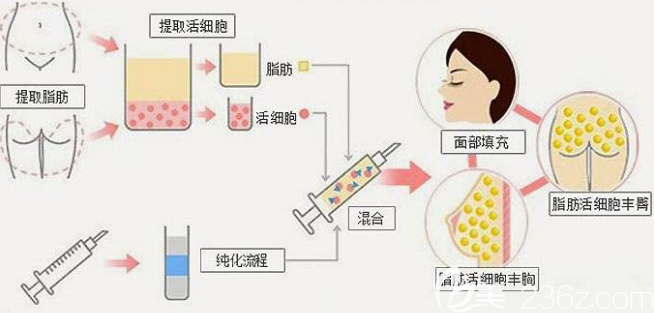自體脂肪移植過(guò)程 自體脂肪移植過(guò)程