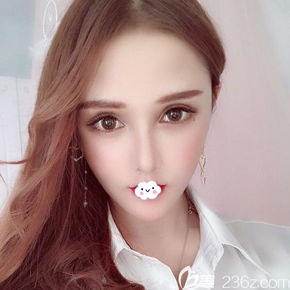 找韓國UcanB整形醫(yī)院金駿昊做魔滴motiva假體隆胸1年后又做了顴骨顴弓整形術(shù)