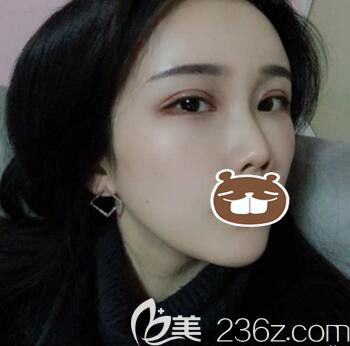 公開我找長(zhǎng)沙亞韓醫(yī)學(xué)美容醫(yī)院易東風(fēng)做自體脂肪填充全臉+全切雙眼皮的親身經(jīng)歷及術(shù)后恢復(fù)過程效果圖！