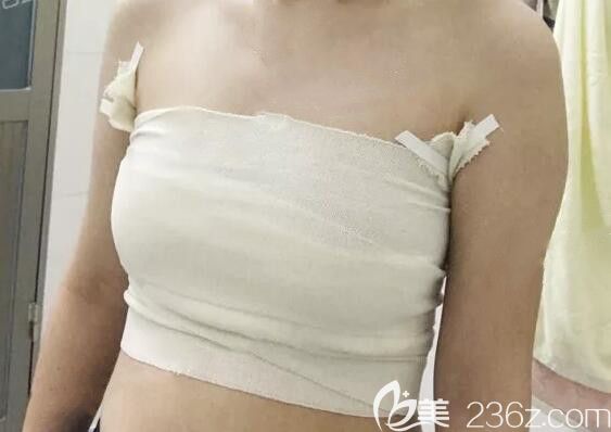 我在南寧美麗星整形做自體脂肪隆胸術(shù)后當(dāng)天照片 我在南寧美麗星整形做自體脂肪隆胸術(shù)后當(dāng)天照片