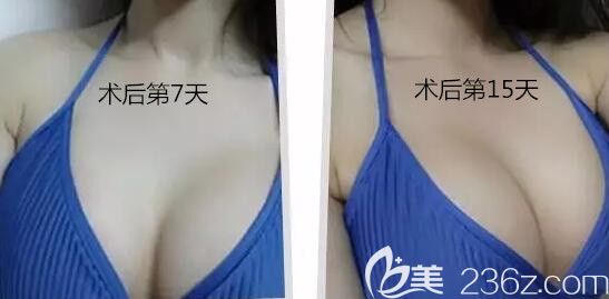 我在南寧美麗星整形做隆胸術(shù)后第7和15天照片 我在南寧美麗星整形做隆胸術(shù)后第7和15天照片