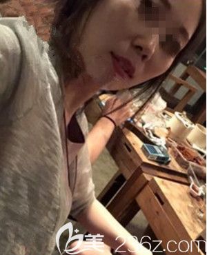 在韓國遇見美做顴骨整形手術(shù)前 在韓國遇見美做顴骨整形手術(shù)前