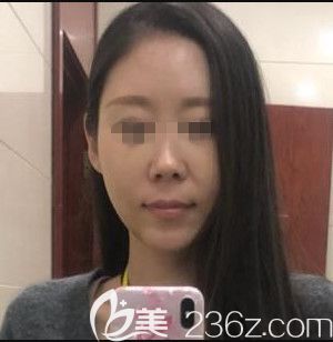 在韓國遇見美做顴骨整形手術(shù)后10天 在韓國遇見美做顴骨整形手術(shù)后10天