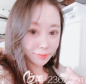 在韓國遇見美做無鈦釘顴骨顴弓整形手術(shù)5個月的恢復(fù)過程分享