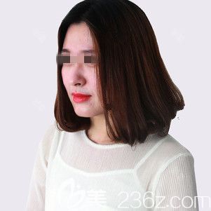 在張家口維多利亞做自體脂肪豐胸術(shù)前是b罩杯 在張家口維多利亞做自體脂肪豐胸術(shù)前是b罩杯