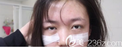 術(shù)后第5天的眼部狀況 術(shù)后第5天的眼部狀況