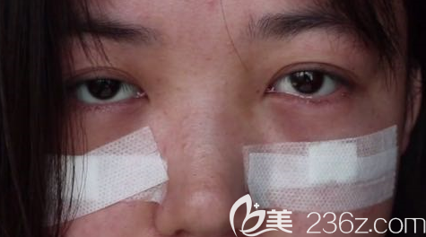 術(shù)后第10天的眼部狀況 術(shù)后第10天的眼部狀況