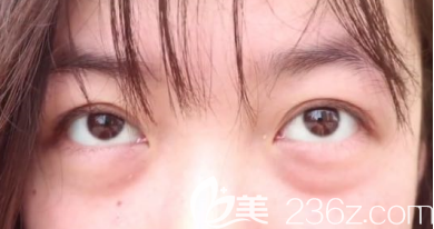 術(shù)前我的眼袋+淚溝樣子 術(shù)前我的眼袋+淚溝樣子