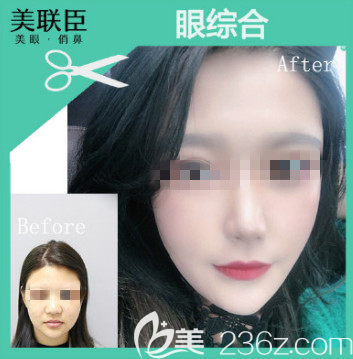 大概2月底去淄博做了去眼袋手術(shù)恢復(fù)了4個(gè)月了，我今天分享我的照片+心得