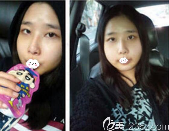 韓國(guó)菲斯萊茵Faceline面部輪廓術(shù)后5天恢復(fù)效果圖