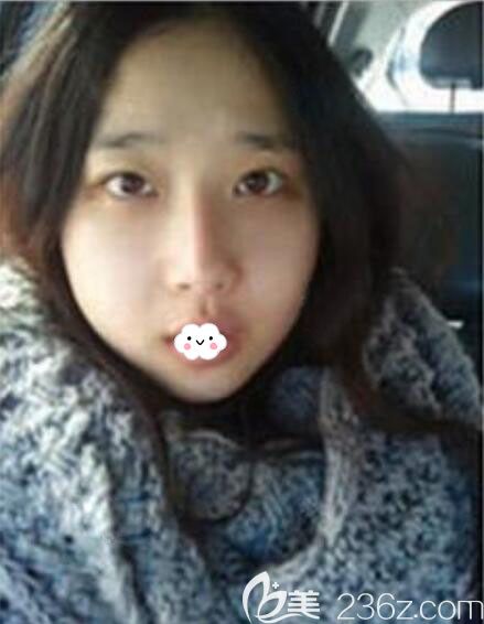 韓國(guó)Faceline隆鼻修復(fù)+雙鄂手術(shù)案例術(shù)后恢復(fù)照片