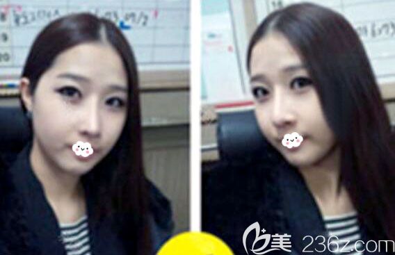 韓國(guó)菲斯萊茵Faceline鼻修復(fù)+面部輪廓整形術(shù)后1個(gè)月恢復(fù)效果