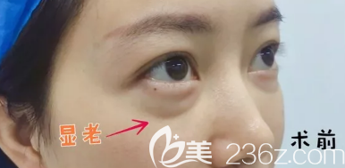 術(shù)前 術(shù)前