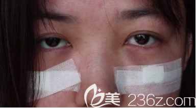 術(shù)后第3天 術(shù)后第3天