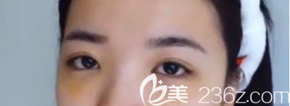 菏澤華美做去眼袋和自體脂肪填充手術(shù)都挺好的，分享我術(shù)后三個(gè)月的恢復(fù)情況