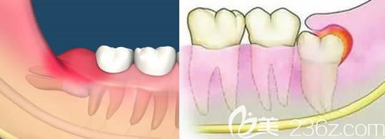 王冠一醫(yī)生講解什么樣的智齒需要拔除