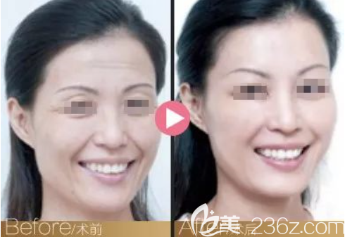 新疆華美超皮秒祛斑