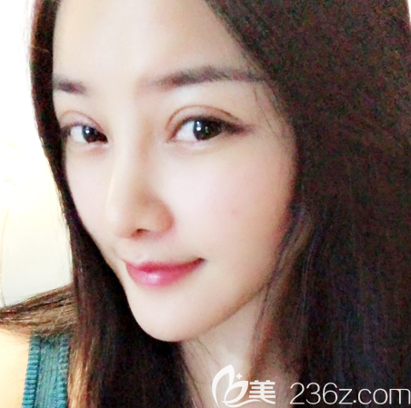 鄒順祿全切雙眼皮術(shù)后四天消腫效果圖 鄒順祿全切雙眼皮術(shù)后四天消腫效果圖