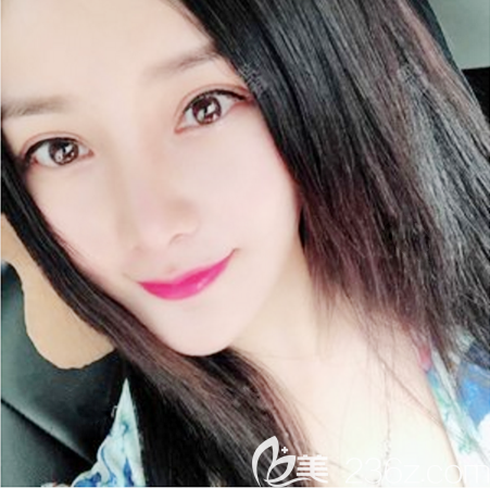 廣州荔醫(yī)鄒順祿醫(yī)生做的全切雙眼皮案例 廣州荔醫(yī)鄒順祿醫(yī)生做的全切雙眼皮案例