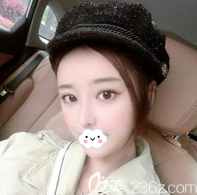 成都天姿（原恒博）整形美容醫(yī)院李烈給我做面部吸脂3個月了，恢復(fù)期的時候我覺得自己每天都不一樣