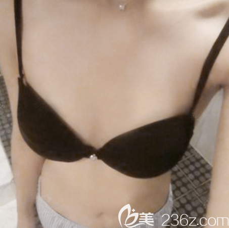 在東莞西妃做隆胸術(shù)前照片 在東莞西妃做隆胸術(shù)前照片