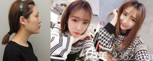 韓國麗珍鼻部整形案例 韓國麗珍鼻部整形案例