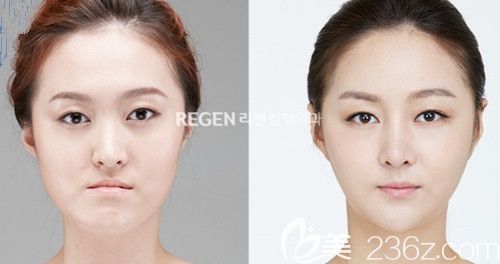 韓國麗珍PRP脂肪填充案例 韓國麗珍PRP脂肪填充案例