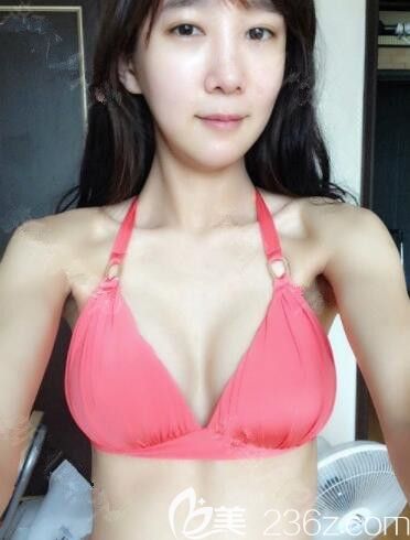 JJ洪鎮(zhèn)柱整形醫(yī)院隆胸真人案例