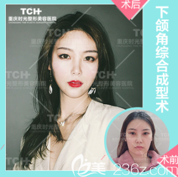 重慶時光下頜角整形案例