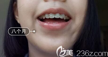 我在洛陽(yáng)九龍口腔做牙齒矯正第8個(gè)月 我在洛陽(yáng)九龍口腔做牙齒矯正第8個(gè)月