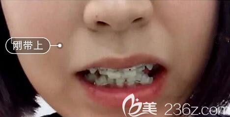 我錯(cuò)亂的牙齒在洛陽(yáng)九龍口腔剛開(kāi)始矯正 我錯(cuò)亂的牙齒在洛陽(yáng)九龍口腔剛開(kāi)始矯正