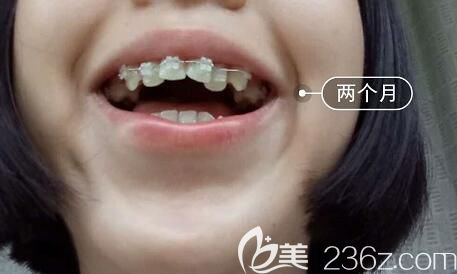 我在洛陽(yáng)九龍口腔做牙齒矯正第2個(gè)月 我在洛陽(yáng)九龍口腔做牙齒矯正第2個(gè)月