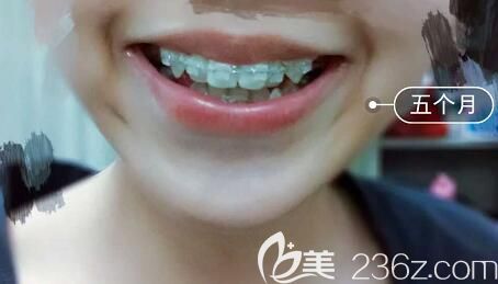 我在洛陽(yáng)九龍口腔做半隱形陶瓷托槽牙齒矯正5個(gè)月 我在洛陽(yáng)九龍口腔做半隱形陶瓷托槽牙齒矯正5個(gè)月