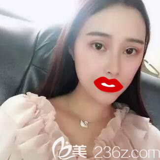 在長(zhǎng)沙做雙眼皮開眼角注射瘦臉術(shù)后45天<span style=