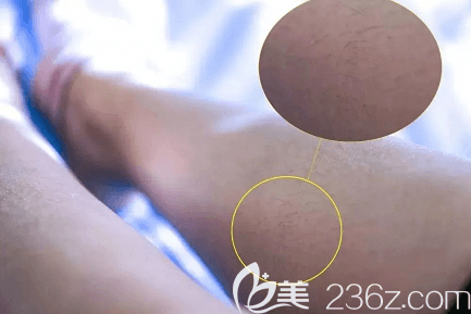 在北京藝星做冰點(diǎn)脫毛前樣子 在北京藝星做冰點(diǎn)脫毛前樣子