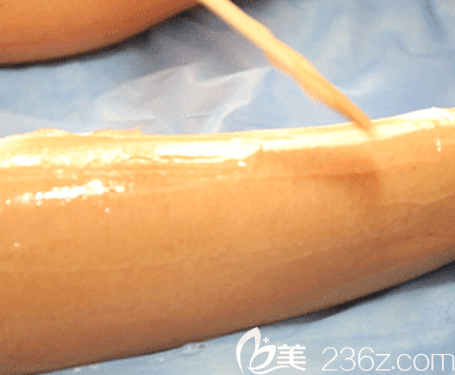 北京藝星醫(yī)生給我腿部抹凝膠樣子 北京藝星醫(yī)生給我腿部抹凝膠樣子