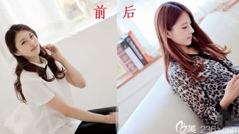 JJ洪鎮(zhèn)柱整形外科醫(yī)院:硅膠隆鼻術(shù) JJ洪鎮(zhèn)柱整形外科醫(yī)院:硅膠隆鼻術(shù)