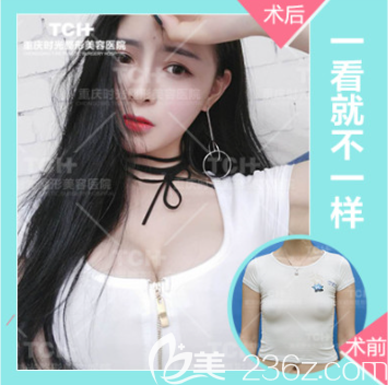 重慶時光整形假體隆胸 重慶時光整形假體隆胸