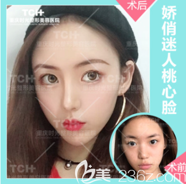 重慶時光整形自體脂肪豐蘋果肌 重慶時光整形自體脂肪豐蘋果肌