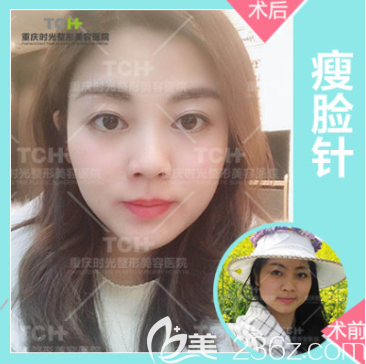重慶時光醫(yī)院打瘦臉效果 重慶時光醫(yī)院打瘦臉效果