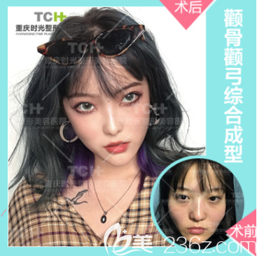 重慶時光整形能磨骨改臉型嗎 重慶時光整形能磨骨改臉型嗎