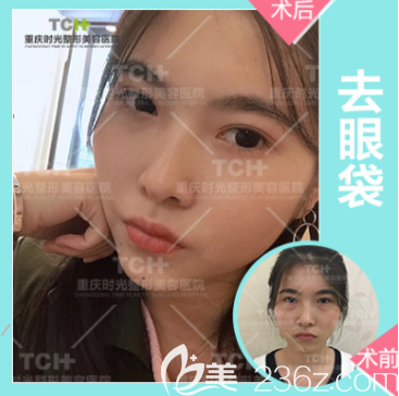 重慶時光整形能祛眼袋嗎 重慶時光整形能祛眼袋嗎