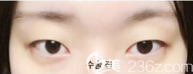 韓國美麗的人整形外科眼綜合真人案例 韓國美麗的人整形外科眼綜合真人案例